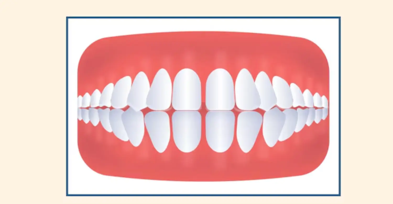 Gap Tooth Treatmen 2